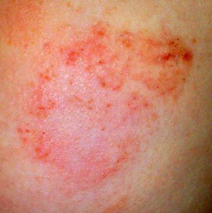 Dermatite: o que  e como evit-la 